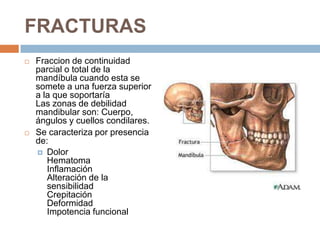 FRACTURAS




Fraccion de continuidad
parcial o total de la
mandíbula cuando esta se
somete a una fuerza superior
a la que soportaría
Las zonas de debilidad
mandibular son: Cuerpo,
ángulos y cuellos condilares.
Se caracteriza por presencia
de:
 Dolor
Hematoma
Inflamación
Alteración de la
sensibilidad
Crepitación
Deformidad
Impotencia funcional

 
