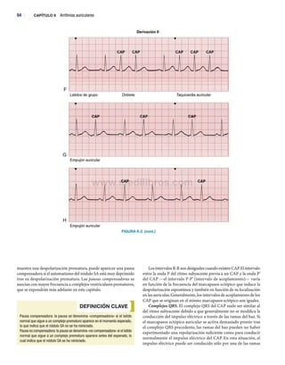 94 : CAPÍTULO 6 Arritmias auriculares
Derivación II
i : ' T 1 ,
c
I
1 1
i;a
1
AP ■
1
; i
I
í | : : | i :
_' ‘ r^---- ^
i , :
Empujón auricular
FIGURA 6-2 (cont.)
muestra una despolarización prematura, puede aparecer una pausa
compensadora si el automatismo del nódulo SA está muy deprimido
tras su despolarización prematura. Las pausas compensadoras se
asocian con mayor frecuencia a complejos ventriculares prematuros,
que se expondrán más adelante en este capítulo.
DEFINICION CLAVE
]
Pausa compensadora: la pausa se denomina «compensadora» si el latido
normal que sigue a un complejo prematuro aparece en el momento esperado,
lo que indica que el nódulo SA no se ha reiniciado.
Pausa no compensadora: la pausa se denomina «no compensadora» si el latido
normal que sigue a un complejo prematuro aparece antes del esperado, lo
cual indica que el nódulo SA se ha reiniciado.
Los intervalos R-R son desiguales cuando existen CAR El intervalo
entre la onda P del ritmo subyacente previa a un CAP y la onda P’
del CAP —el intervalo P-P’ (intervalo de acoplamiento)— varía
en función de la frecuencia del marcapasos ectópico que induce la
despolarización espontánea y también en función de su localización
en las aurículas. Generalmente, los intervalos de acoplamiento de los
CAP que se originan en el mismo marcapasos ectópico son iguales.
Complejos QRS. El complejo QRS del CAP suele ser similar al
del ritmo subyacente debido a que generalmente no se modifica la
conducción del impulso eléctrico a través de las ramas del haz. Si
el marcapasos ectópico auricular se activa demasiado pronto tras
el complejo QRS precedente, las ramas del haz pueden no haber
experimentado una repolarización suficiente como para conducir
normalmente el impulso eléctrico del CAP. En esta situación, el
impulso eléctrico puede ser conducido sólo por una de las ramas
 