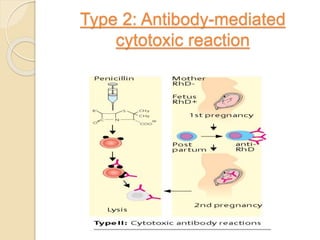 Type 2: Antibody-mediated
cytotoxic reaction
 