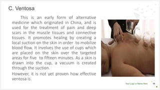 Your Logo or Name Here
This is an early form of alternative
medicine which originated in China, and is
used for the treatment of pain and deep
scars in the muscle tissues and connective
tissues. It promotes healing by creating a
local suction on the skin in order to mobilize
blood flow. It involves the use of cups which
are placed on the skin over the targeted
areas for five to fifteen minutes. As a skin is
drawn into the cup, a vacuum is created
through the suction.
However, it is not yet proven how effective
ventosa is.
C. Ventosa
16
 