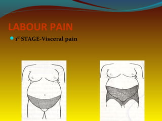 LABOUR PAIN
1ST
STAGE-Visceral pain
 