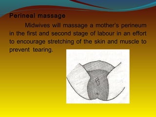 Perineal massage
Midwives will massage a mother’s perineum
in the first and second stage of labour in an effort
to encourage stretching of the skin and muscle to
prevent tearing.
 
