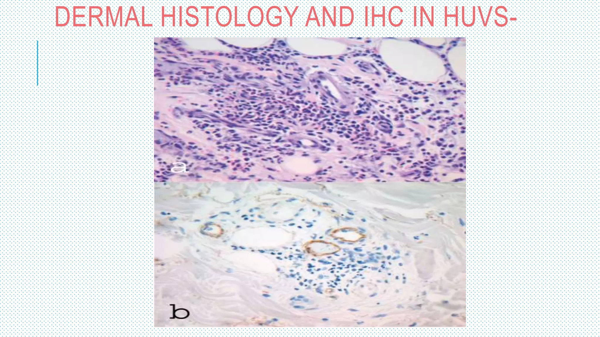 DERMAL HISTOLOGY AND IHC IN HUVS-
 
