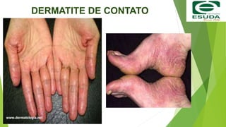 DERMATITE DE CONTATO
 