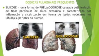 DOENÇAS PULMONARES FREQUENTES
 SILICOSE - uma forma de PNEUMOCONIOSE causada pela inalação
de finas partículas de sílica cristalina e caracterizada por
inflamação e cicatrização em forma de lesões nodulares nos
lóbulos superiores do pulmão.
 