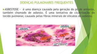 DOENÇAS PULMONARES FREQUENTES
ASBESTOSE - é uma doença causada pela geração do pó de amianto,
também chamado de asbesto. É uma tentativa de cicatrização do
tecido pulmonar, causada pelas fibras minerais de silicatos do asbesto.
 