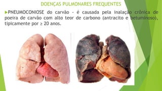 DOENÇAS PULMONARES FREQUENTES
PNEUMOCONIOSE do carvão - é causada pela inalação crônica de
poeira de carvão com alto teor de carbono (antracito e betuminoso),
tipicamente por ≥ 20 anos.
 