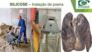 SILICOSE – Inalação de poeira
 