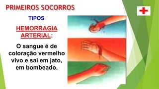 HEMORRAGIA
ARTERIAL:
O sangue é de
coloração vermelho
vivo e sai em jato,
em bombeado.
TIPOS
 