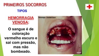 HEMORRAGIA
VENOSA:
O sangue é de
coloração
vermelho escuro e
sai com pressão,
mas não
bombeado.
TIPOS
 