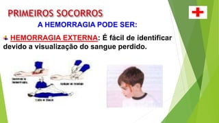 A HEMORRAGIA PODE SER:
HEMORRAGIA EXTERNA: É fácil de identificar
devido a visualização do sangue perdido.
 