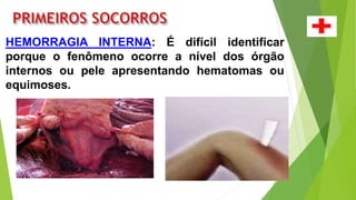 HEMORRAGIA INTERNA: É difícil identificar
porque o fenômeno ocorre a nível dos órgão
internos ou pele apresentando hematomas ou
equimoses.
 