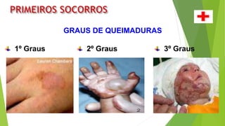 GRAUS DE QUEIMADURAS
1º Graus 2º Graus 3º Graus
 