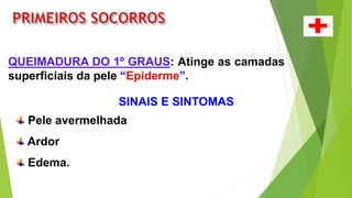 QUEIMADURA DO 1º GRAUS: Atinge as camadas
superficiais da pele “Epiderme”.
SINAIS E SINTOMAS
Pele avermelhada
Ardor
Edema.
 