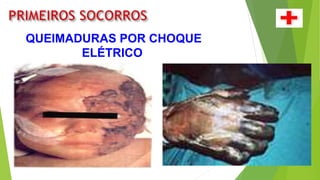 QUEIMADURAS POR CHOQUE
ELÉTRICO
 