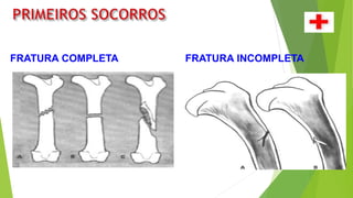 FRATURA COMPLETA FRATURA INCOMPLETA
 