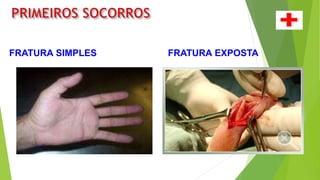 FRATURA SIMPLES FRATURA EXPOSTA
 