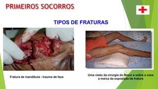 TIPOS DE FRATURAS
Fratura de mandíbula - trauma de face
Uma visão da cirurgia do fêmur e sobre a coxa
a marca da exposição da fratura
 