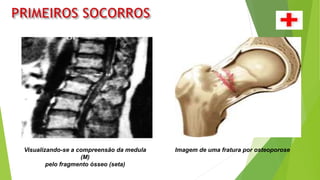 Visualizando-se a compreensão da medula
(M)
pelo fragmento ósseo (seta)
Imagem de uma fratura por osteoporose
 