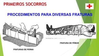 PROCEDIMENTOS PARA DIVERSAS FRATURAS
FRATURAS DE PERNA
FRATURA DE FÊMUR
 