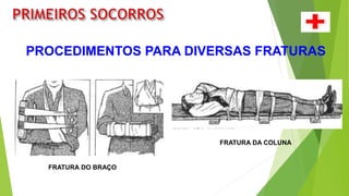 PROCEDIMENTOS PARA DIVERSAS FRATURAS
FRATURA DO BRAÇO
FRATURA DA COLUNA
 