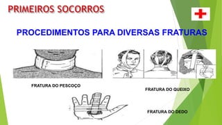 PROCEDIMENTOS PARA DIVERSAS FRATURAS
FRATURA DO PESCOÇO
FRATURA DO DEDO
FRATURA DO QUEIXO
 