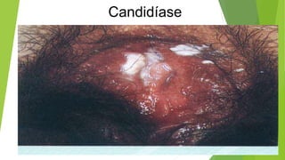 Candidíase
 