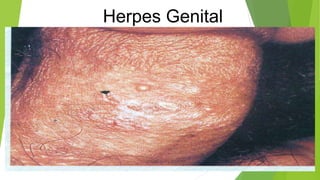 Herpes Genital
 