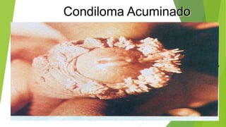 Condiloma Acuminado
 