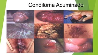 Condiloma Acuminado
 