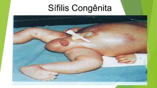 Sífilis Congênita
 