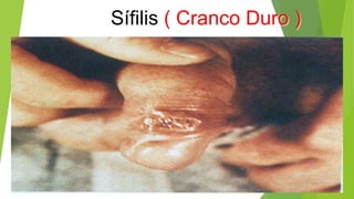 Sífilis ( Cranco Duro )
 
