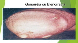 Gonorréia ou Blenorragia
 