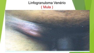 Linfogranuloma Venério
( Mula )
 