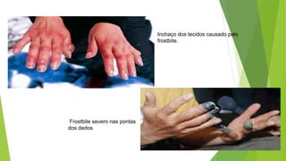 Inchaço dos tecidos causado pelo
frostbite.
Frostbite severo nas pontas
dos dedos
 