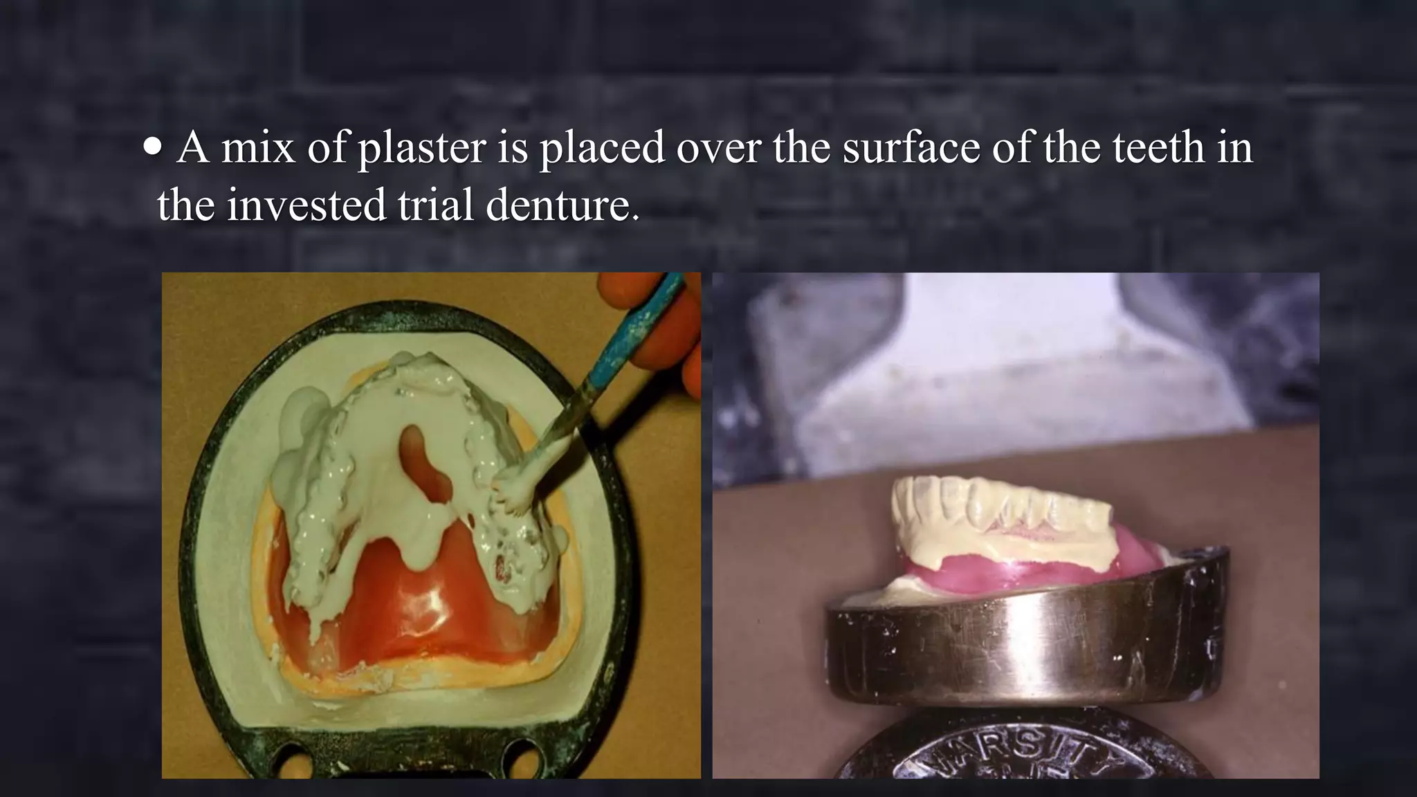  A mix of plaster is placed over the surface of the teeth in

the invested trial denture.

 