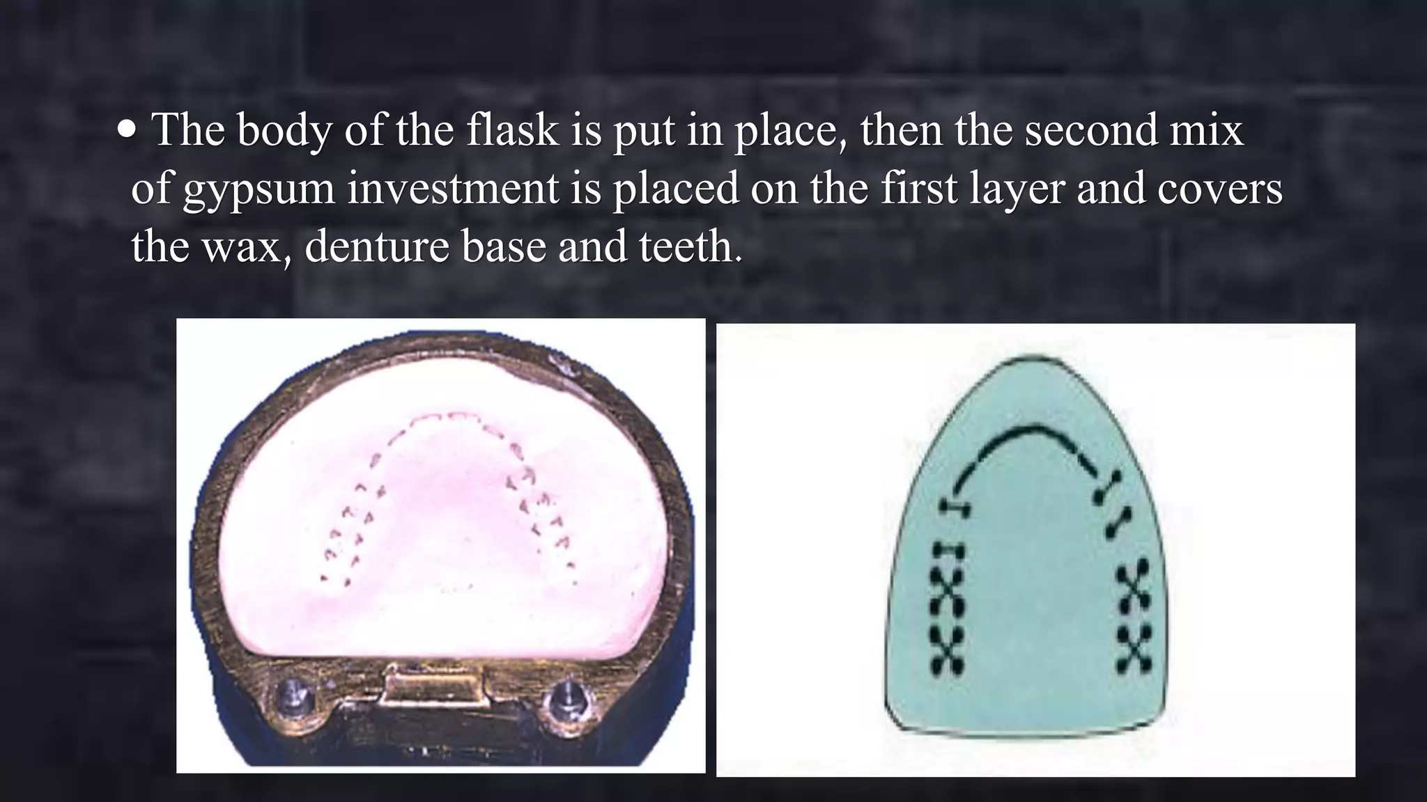  The body of the flask is put in place, then the second mix

of gypsum investment is placed on the first layer and covers
the wax, denture base and teeth.

 