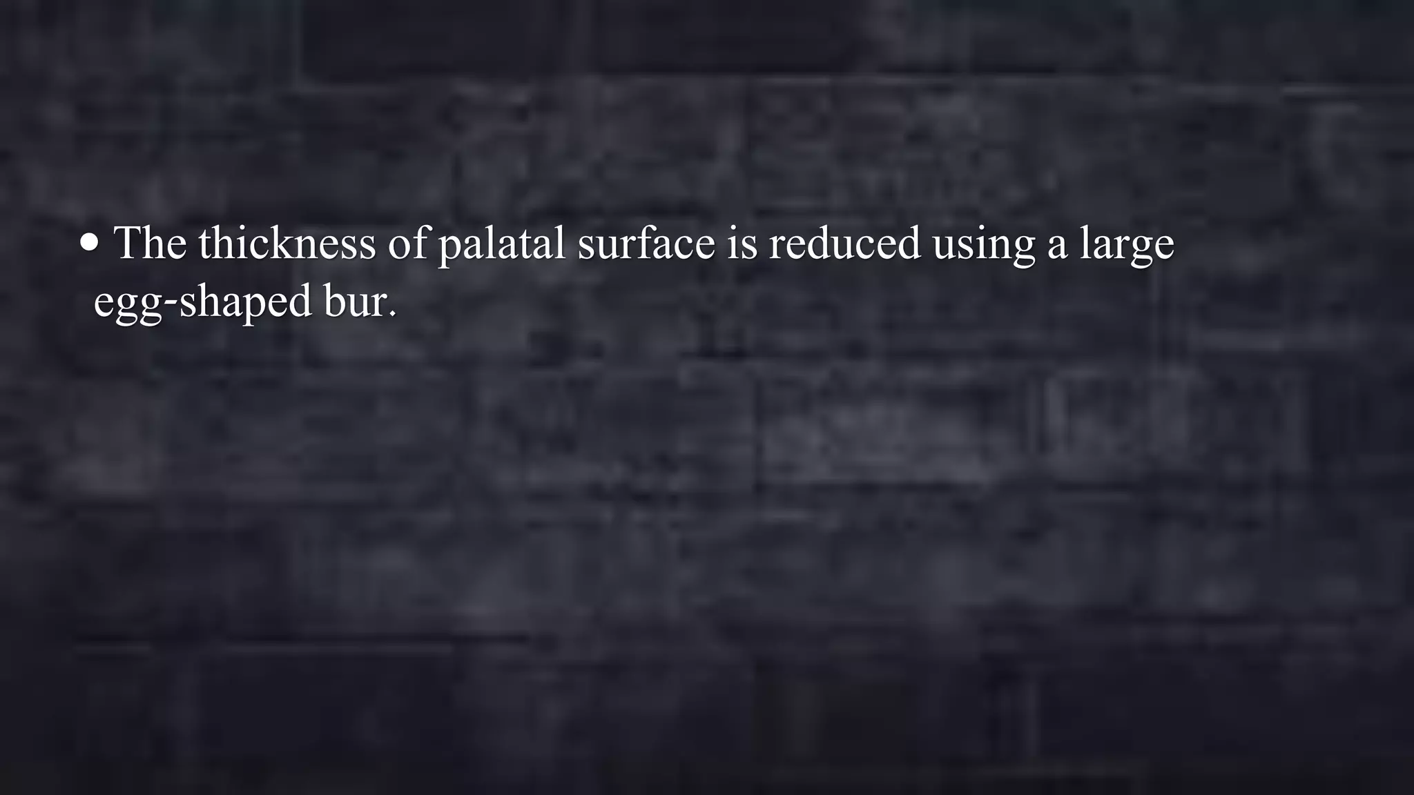  The thickness of palatal surface is reduced using a large

egg-shaped bur.

 