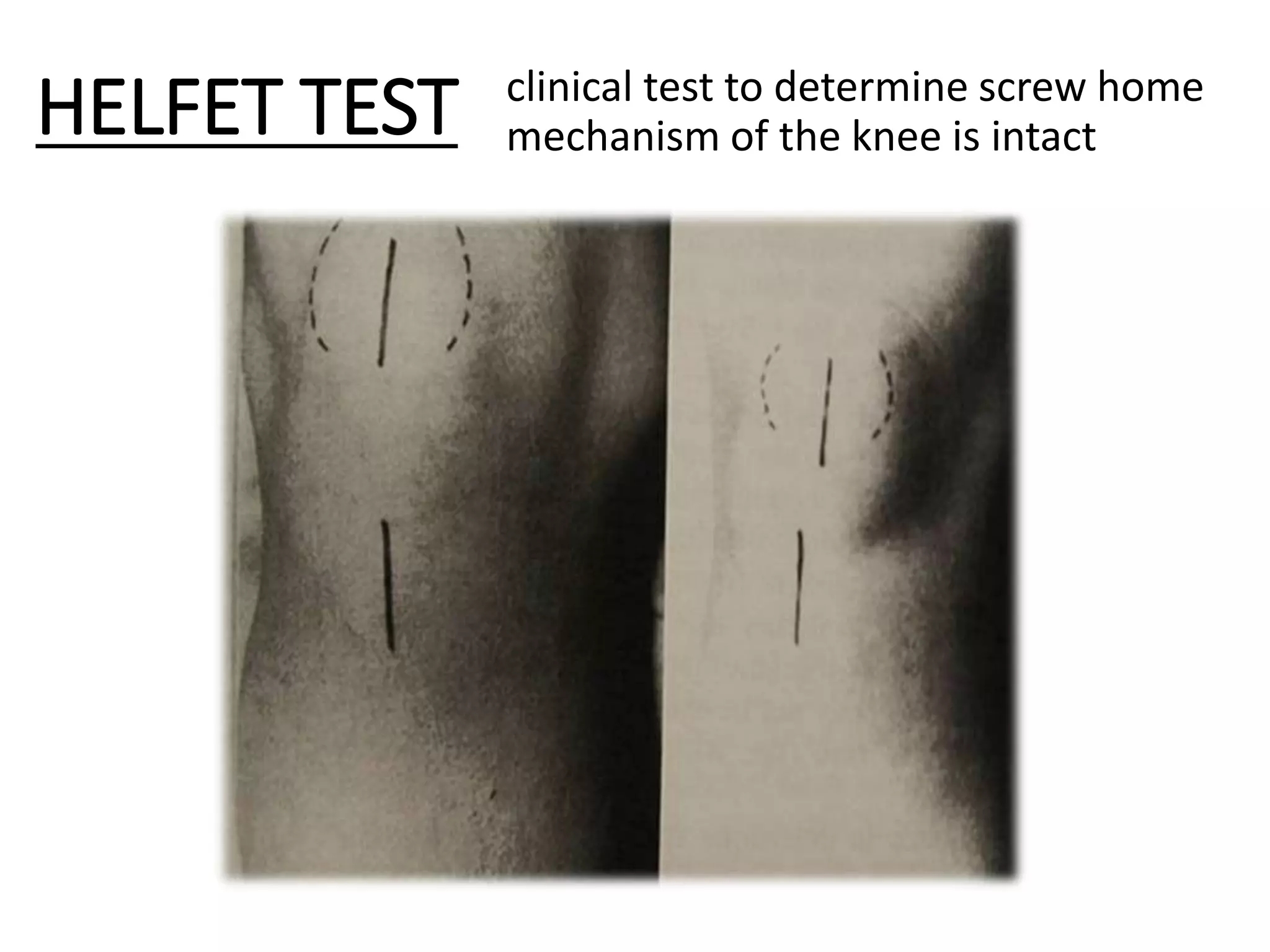 biomechanic of knee joint | PPTX