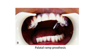 Maxillary Ramps Completed-657566381-Mandibular-Defects.pptx