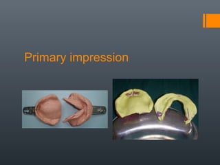 Primary impression