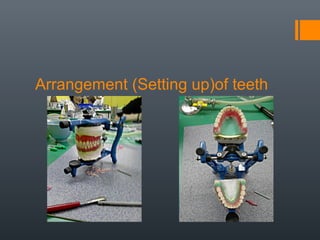 Arrangement (Setting up)of teeth