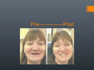 Pre--------------Post