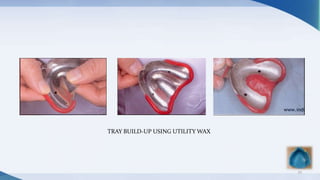 25
TRAY BUILD-UP USING UTILITY WAX
 