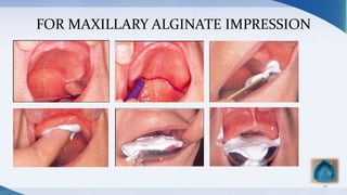 FOR MAXILLARY ALGINATE IMPRESSION
26
 