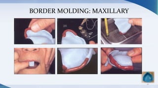 BORDER MOLDING: MAXILLARY
40
 
