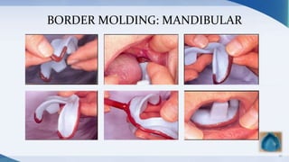 BORDER MOLDING: MANDIBULAR
42
 