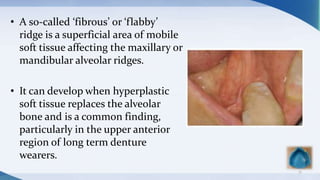 • A so-called ‘fibrous’ or ‘flabby’
ridge is a superficial area of mobile
soft tissue affecting the maxillary or
mandibular alveolar ridges.
• It can develop when hyperplastic
soft tissue replaces the alveolar
bone and is a common finding,
particularly in the upper anterior
region of long term denture
wearers.
71
 