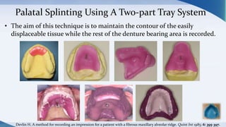 Palatal Splinting Using A Two-part Tray System
• The aim of this technique is to maintain the contour of the easily
displaceable tissue while the rest of the denture bearing area is recorded.
Devlin H. A method for recording an impression for a patient with a fibrous maxillary alveolar ridge. Quint Int 1985; 6: 395-397.
 