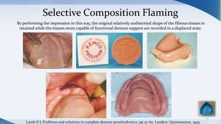 Selective Composition Flaming
77
By performing the impression in this way, the original relatively undistorted shape of the fibrous tissues is
retained while the tissues more capable of functional denture support are recorded in a displaced state.
Lamb D J. Problems and solutions in complete denture prosthodontics. pp 57-60. London: Quintessence, 1993.
 